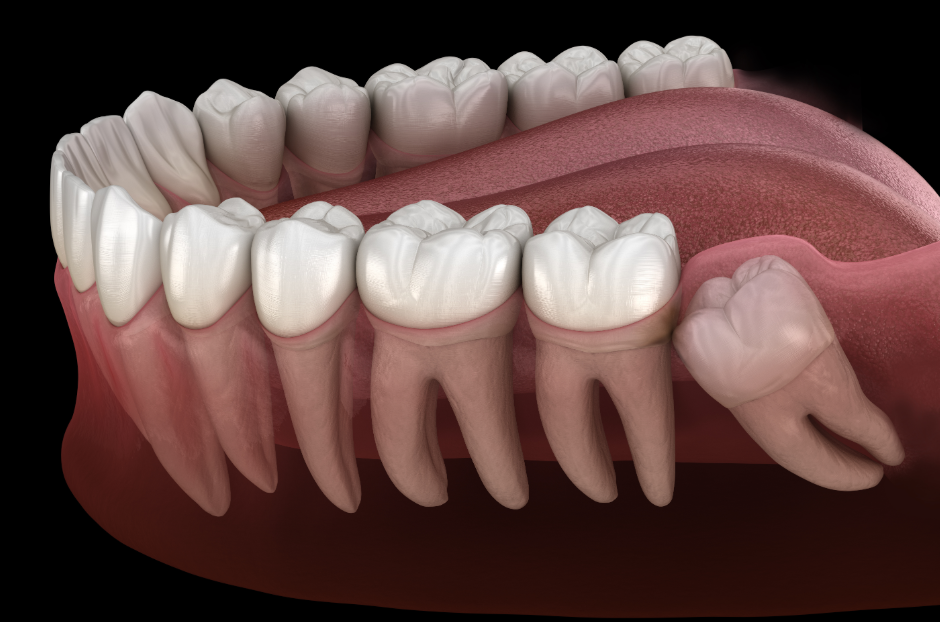 3D image of wisdom teeth